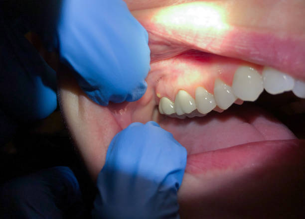 Best Emergency Denture Repair in Glouster, OH